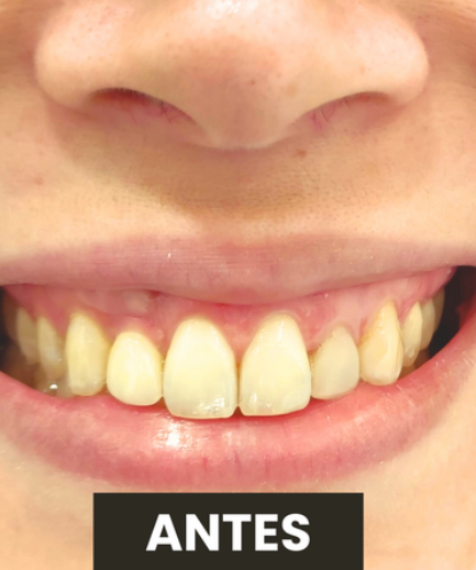 Antes — Correção de Sorriso Gengival