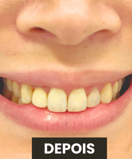Depois — Correção de Sorriso Gengival