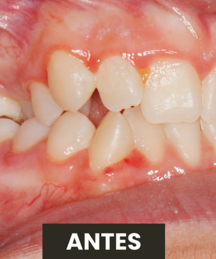 Antes — Tratamento Ortodôntico Invisalign