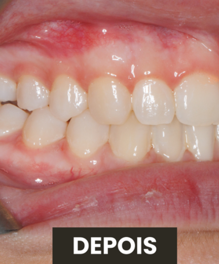 Depois — Tratamento Ortodôntico Invisalign