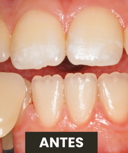 Antes — Branqueamento Dentário
