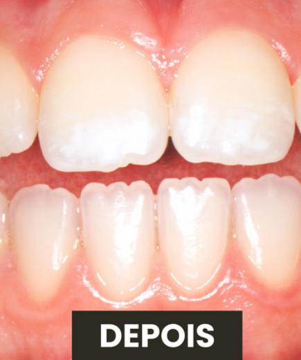 Depois — Branqueamento Dentário