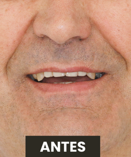 Antes — Protocolo All-on-Four