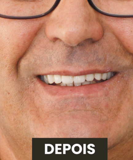 Depois — Protocolo All-on-Four