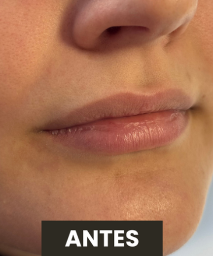 Antes — Preenchimento Labial