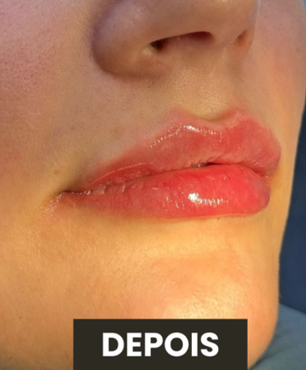 Depois — Preenchimento Labial