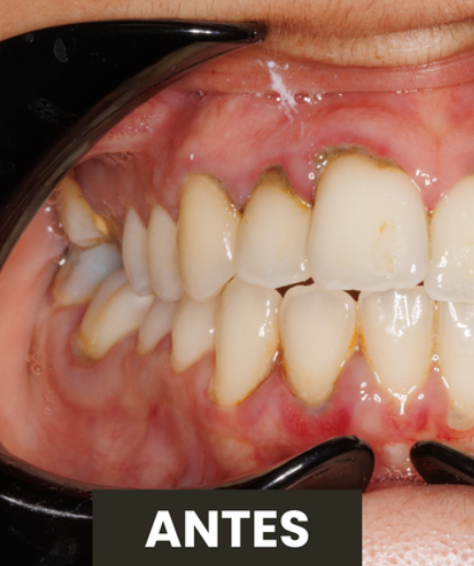 Antes — Higiene Oral