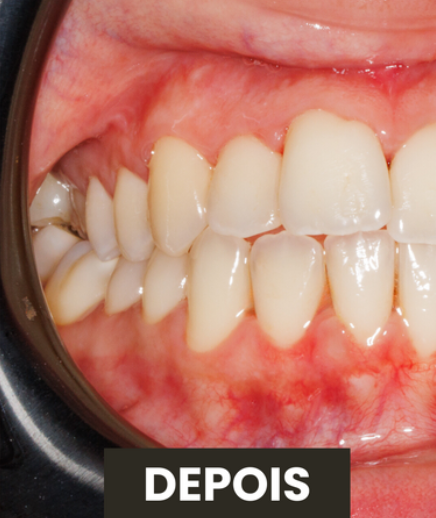 Depois — Higiene Oral